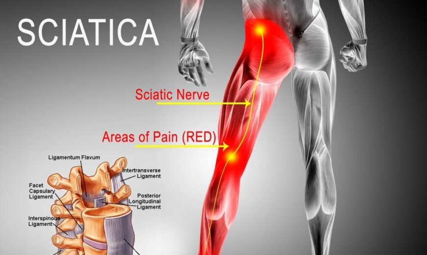 sciatica