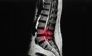 how to cure from sciatica pain