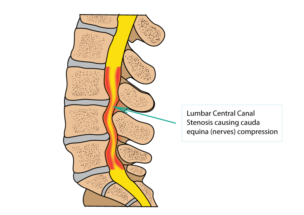 stenosis Physiotherapytreatment at home