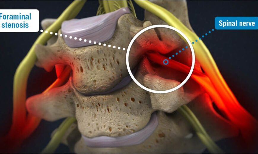 foraminal stenosis 3d render