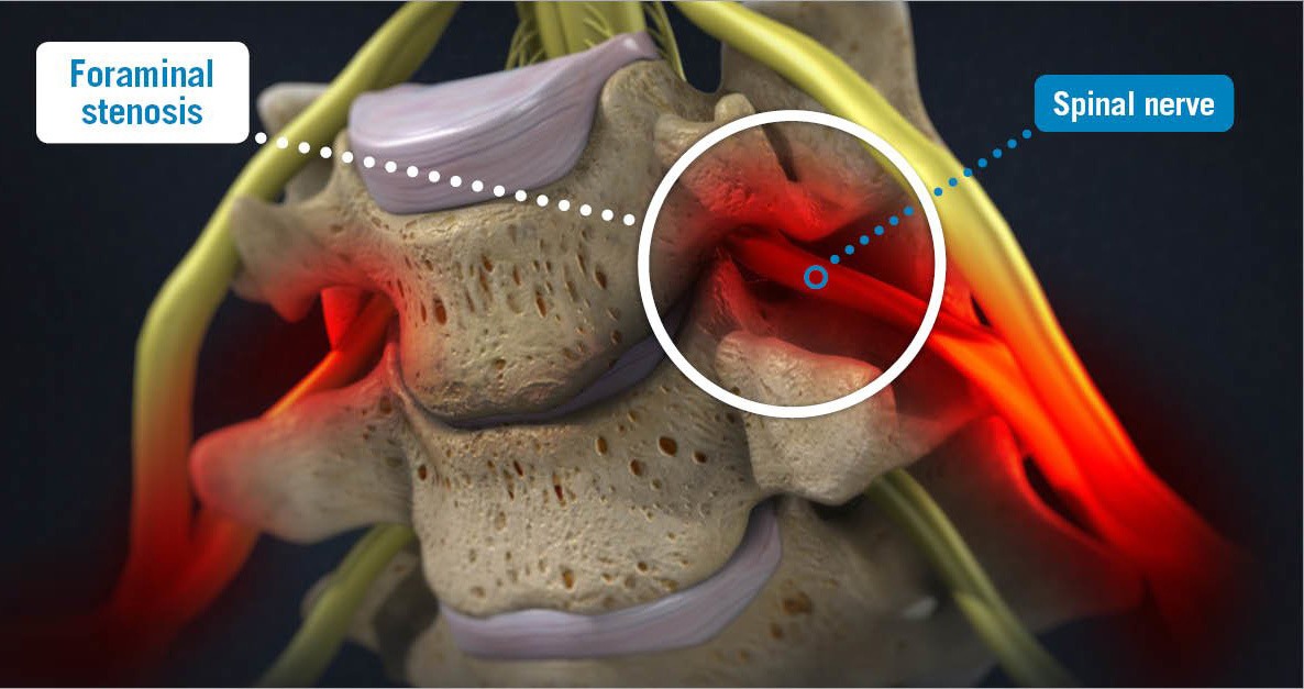 foraminal stenosis 3d render