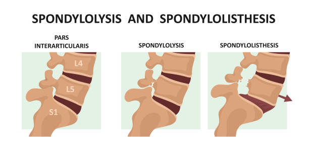 Spondylolisthesis physiotherapy treatment