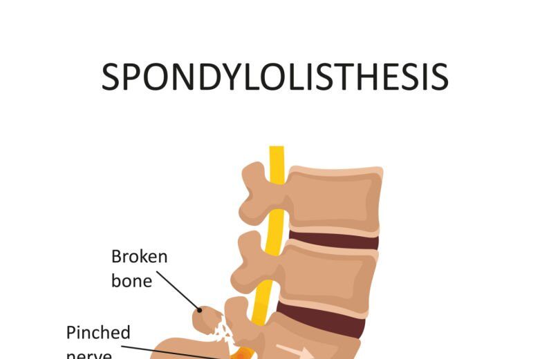 Spondylolisthesis treatment