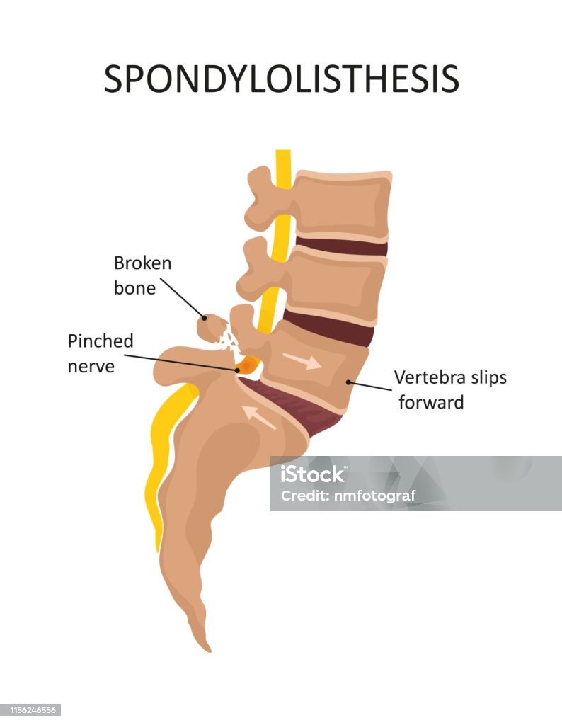 Spondylolisthesis treatment
