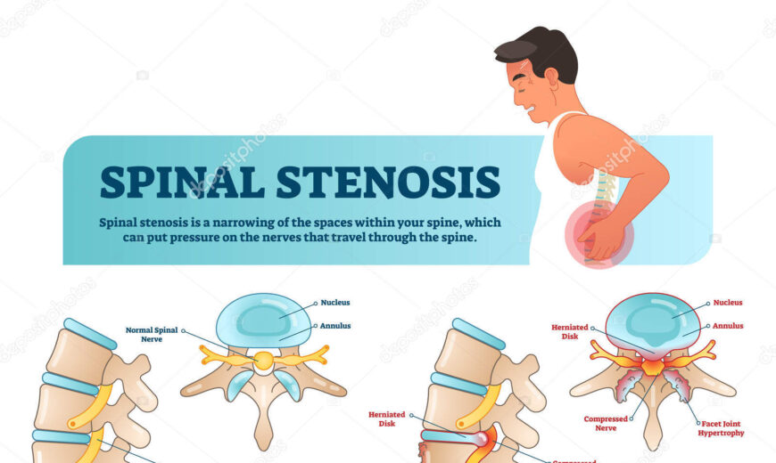 Spinal Stenosis
