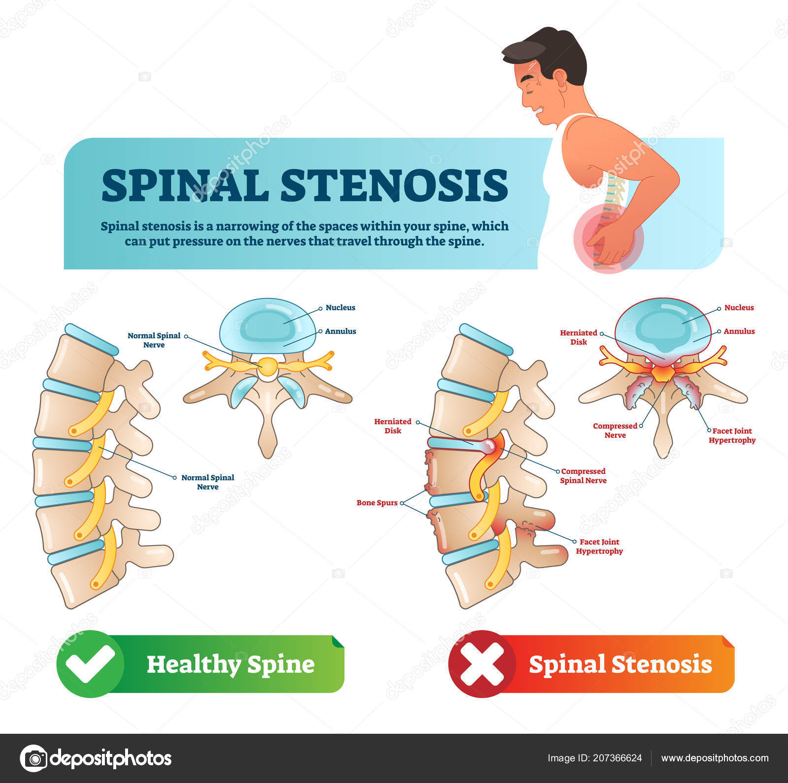 Spinal Stenosis