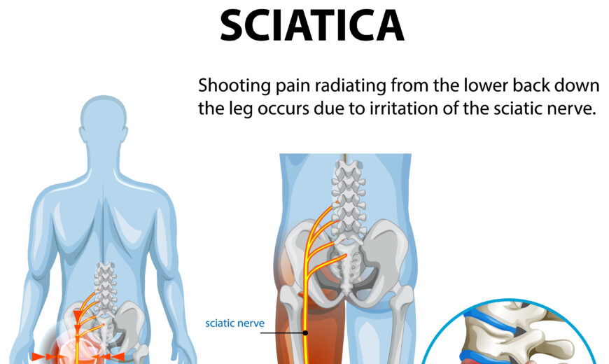 Sciatica pain physiotherapy treatment and exercises
