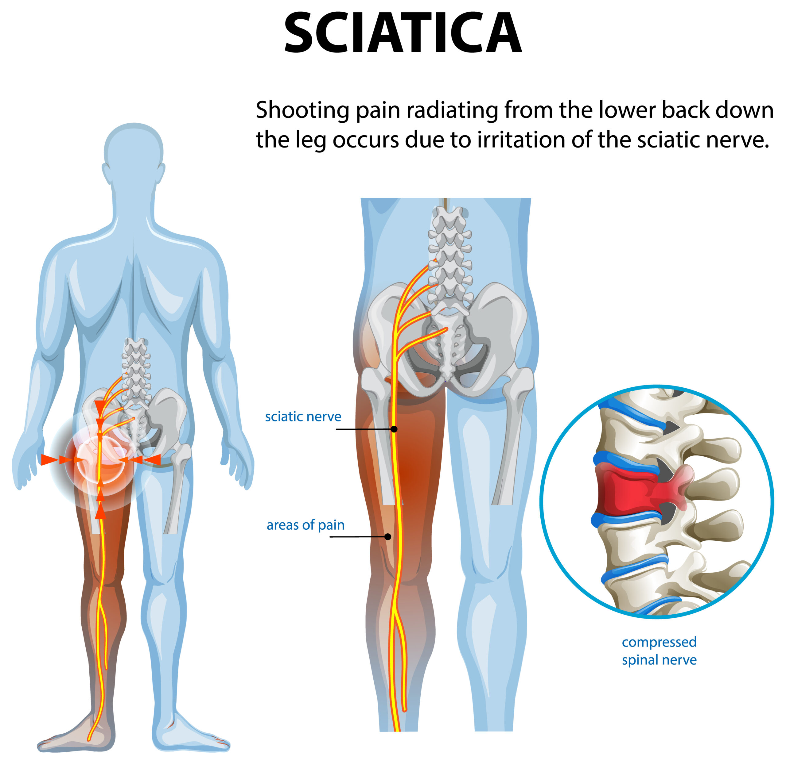 Sciatica pain physiotherapy treatment and exercises